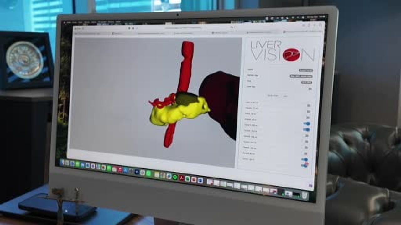Pankreas kanserinde seçilmiş vakillere yeni cerrahi ve ilaç kombinasyonları umut veriyor