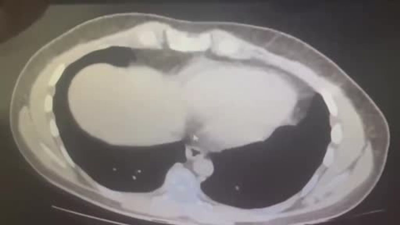Kars'ta İran uyruklu kuryenin midesinden 571,91 gram metamfetamin çıktı