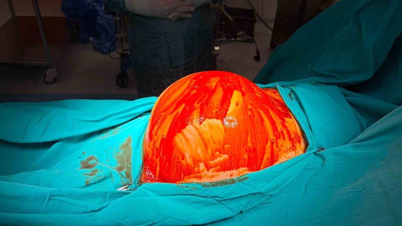 Kocaeli'de 1,5 yıl ertelenen ameliyatta 6,5 kilogramlık böbrek tümörü alındı