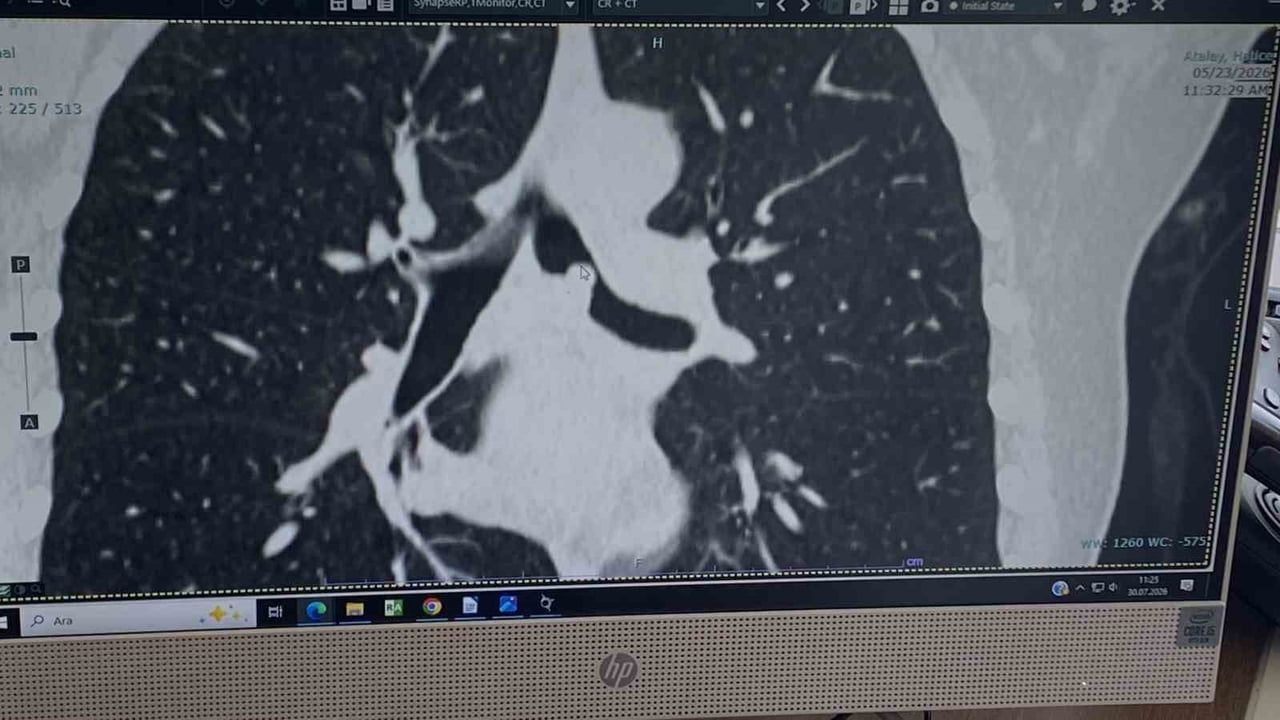 Akciğer korunarak yapılan ameliyatla sol ana bronştaki tümör çıkarıldı