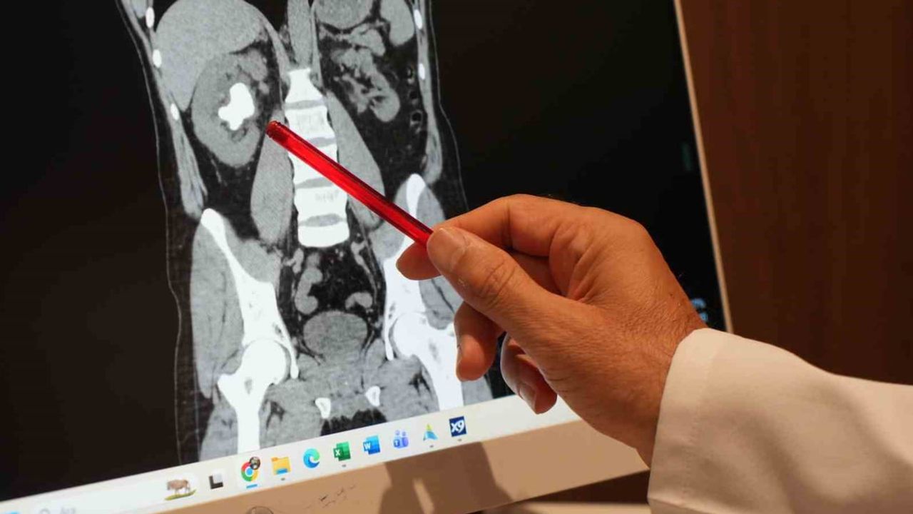 Sırtından girilerek çıkarılan 25 cm küplük böbrek taşı, erken tanı hayat kurtarıyor
