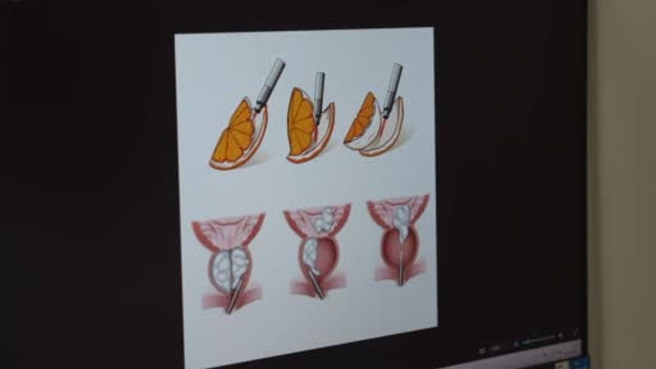 Yaşla artan prostat büyümesinde lazerle kapalı tedavi öne çıkıyor