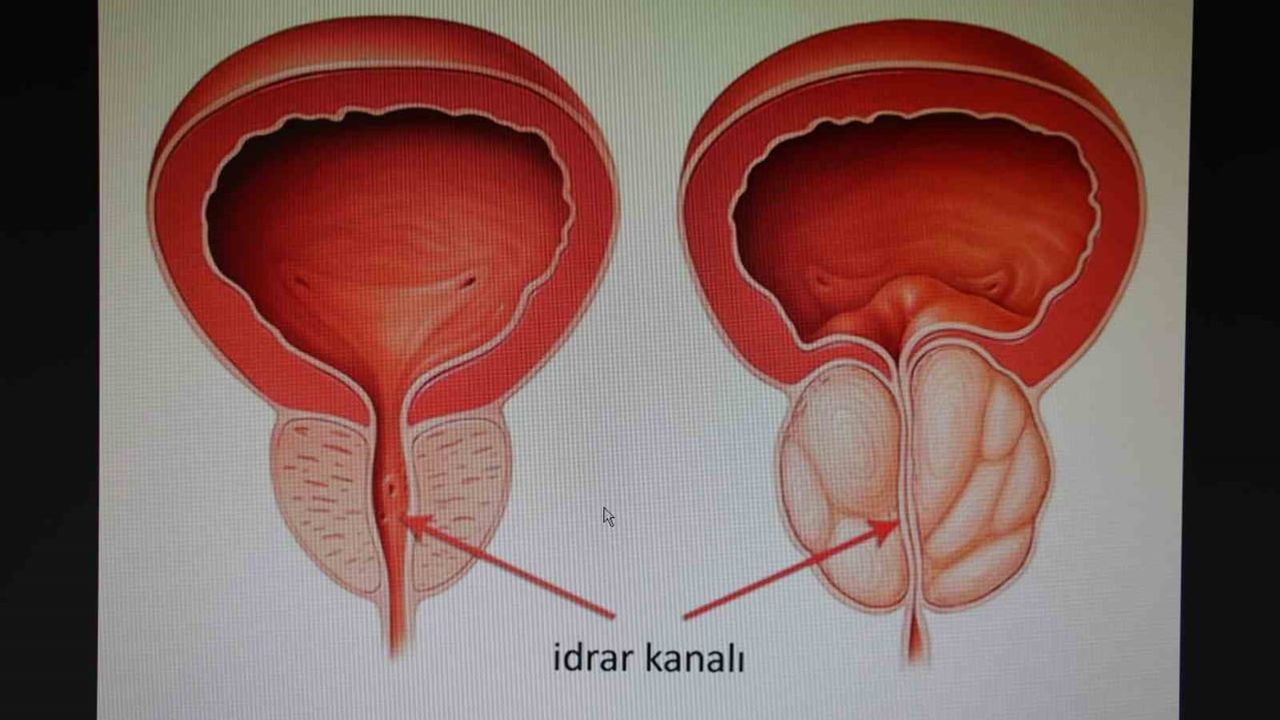 Erkeklerde 50 yaş sonrası prostat kontrolü hayat kurtarıyor