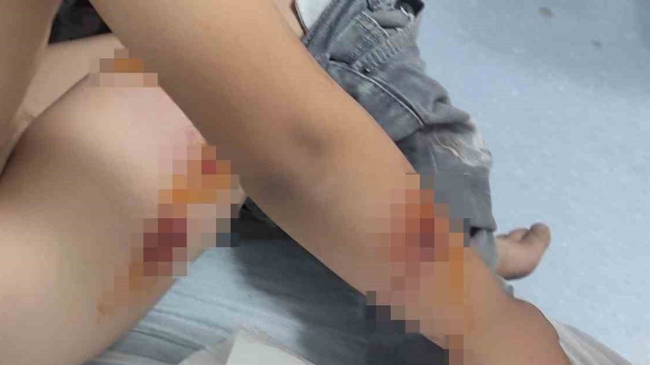 Mahallede sürü halindeki köpeklerin saldırısı: ilkokul öğrencisine 15 dikiş