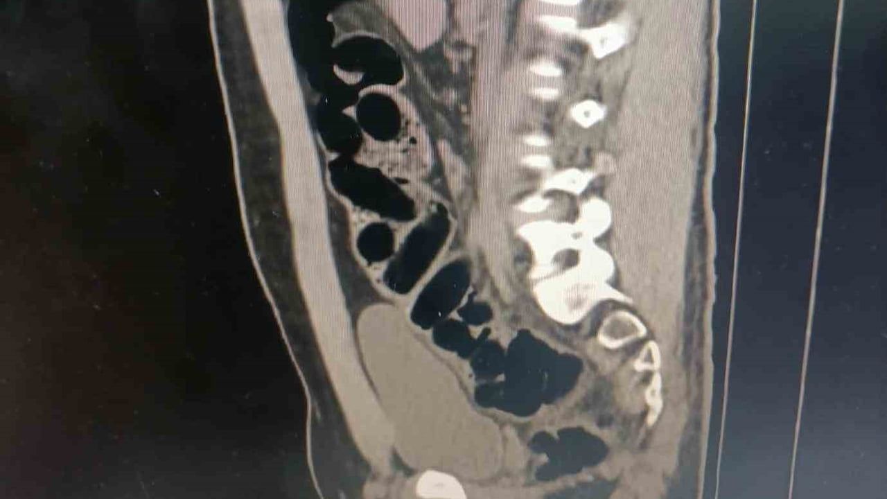 Midesinden 89 kapsülle 943,77 gram eroin çıkan İran uyruklu tutuklandı