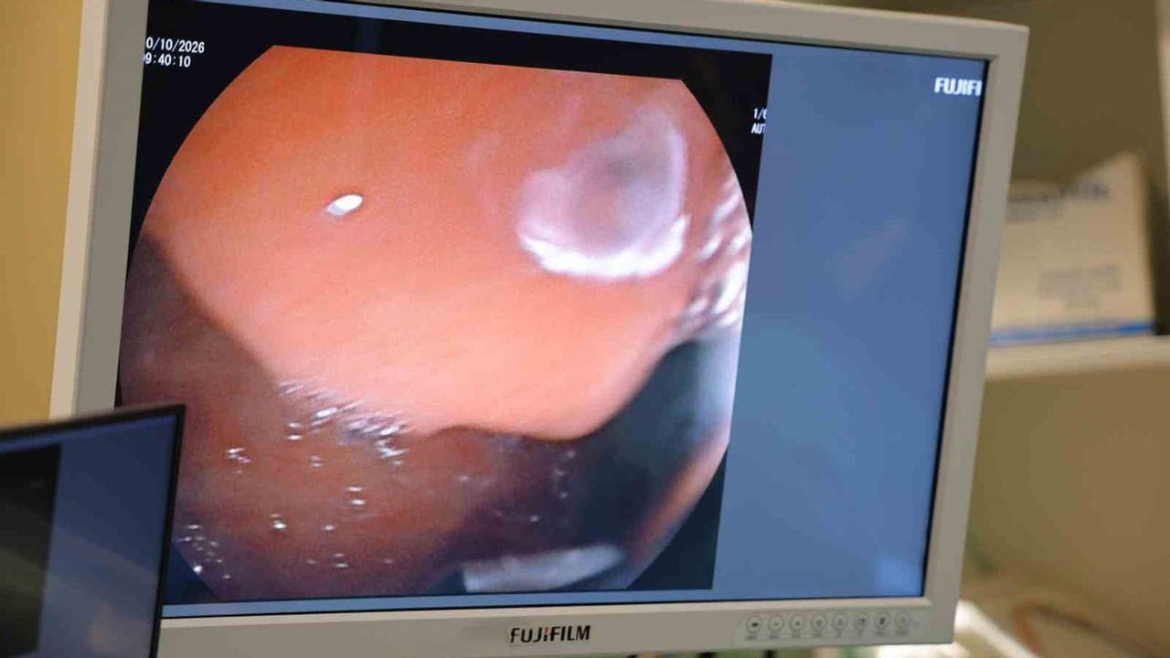 pankreas hastalıklarında erken tanı için EUS ve ERCP'nin rolü