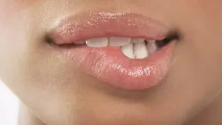 Dudak Yeme Alışkanlığı Nedir, Neden Olur ve Nasıl Önlenir?