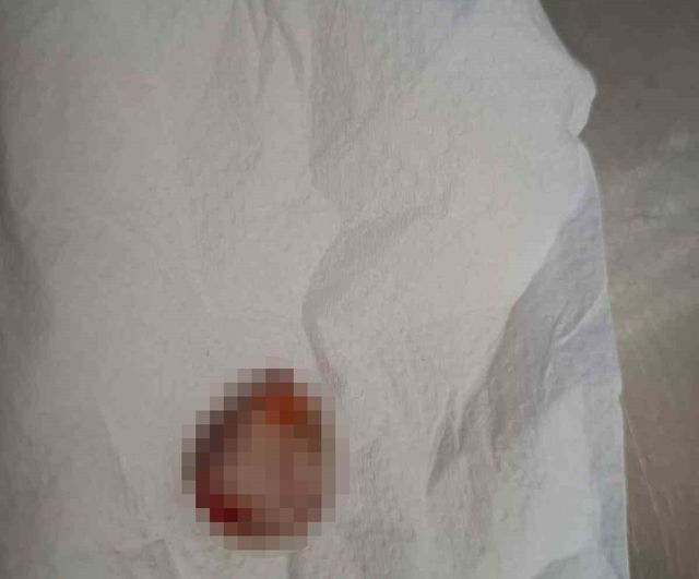 Kopan Parmağını Buz Torbasında Koruyup Türkiye'ye Geldi; 14 Saat Sonra Başarıyla Dikildi