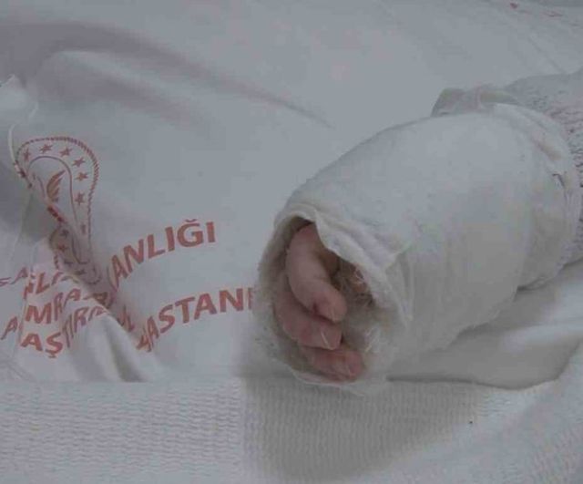 İstanbul'da kaynar su kazası: 20 aylık bebeğin vücudunun yüzde 27'si yandı
