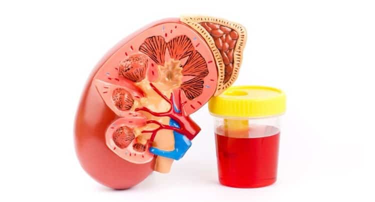 Böbreklerinizde Sorun Olduğunu Gösteren 10 Semptom