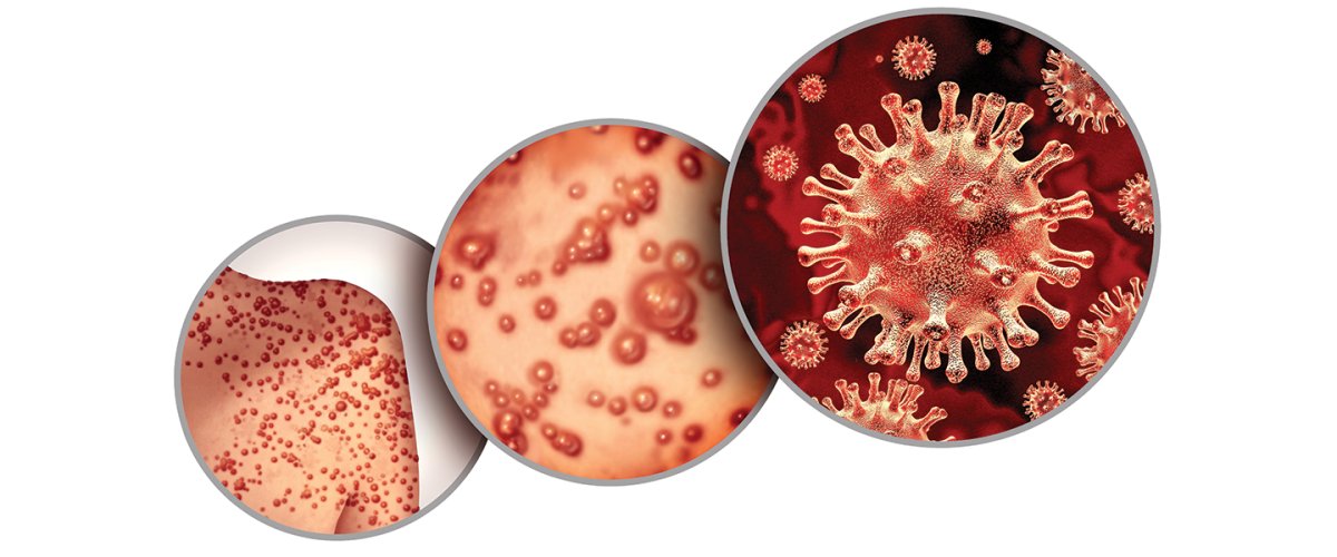Maymun Çiçeği Virüsü: Covid-19 Sonrası Yeni Bir Tehdit mi?