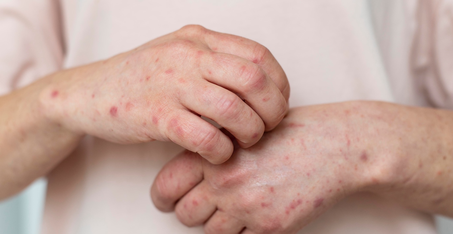 Büyük uzmandan akıl alacak uyarı! Cüzzam halen daha büyük problem