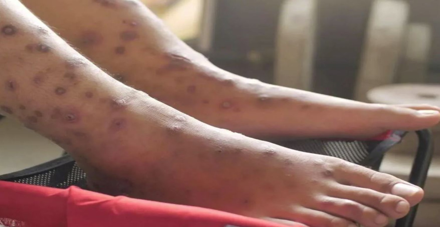 candida auris kimlerde görülür