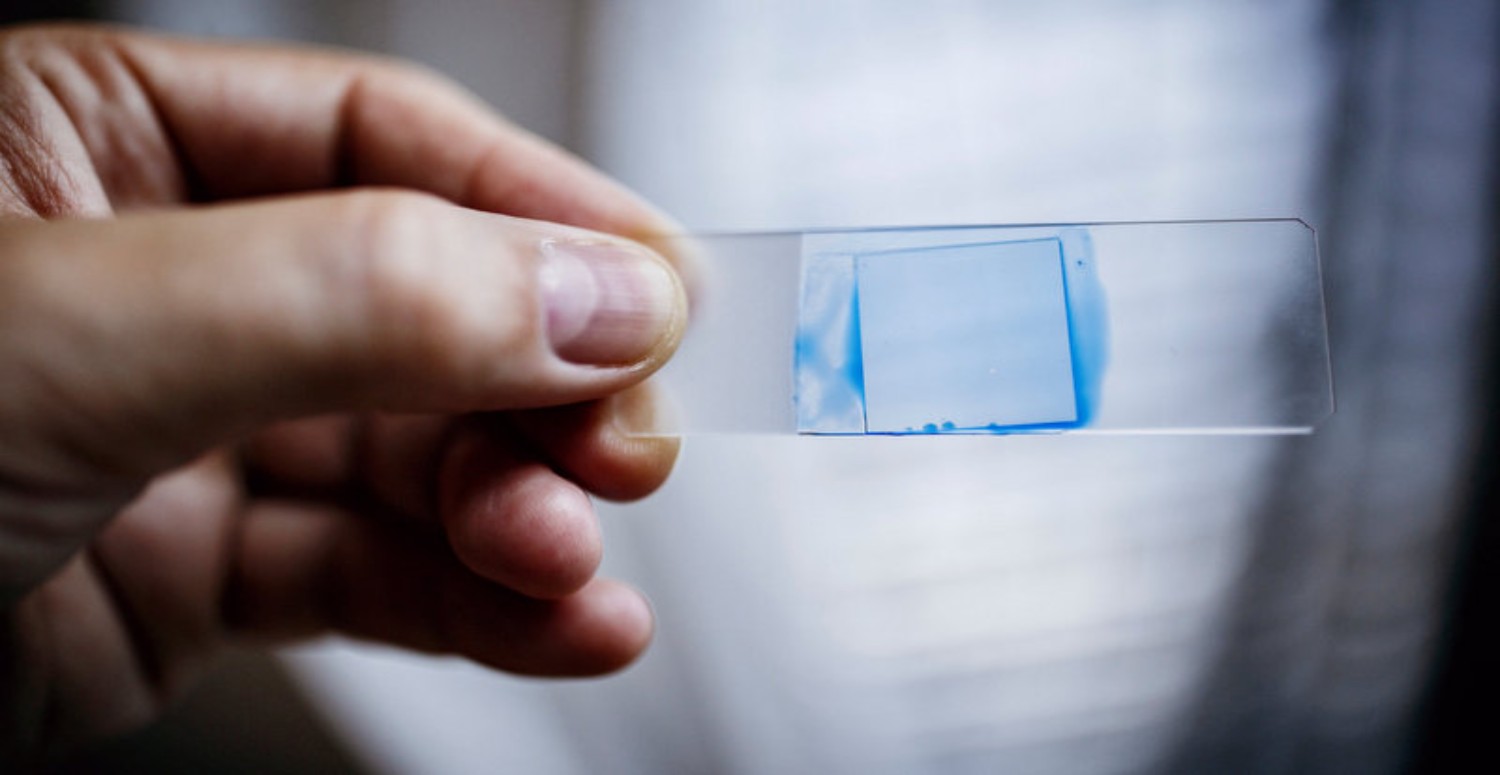 candida auris tedavisi