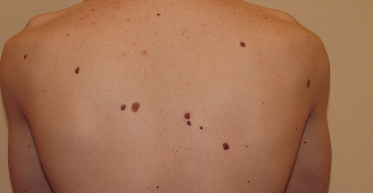 ciltteki benler neyin habercisi