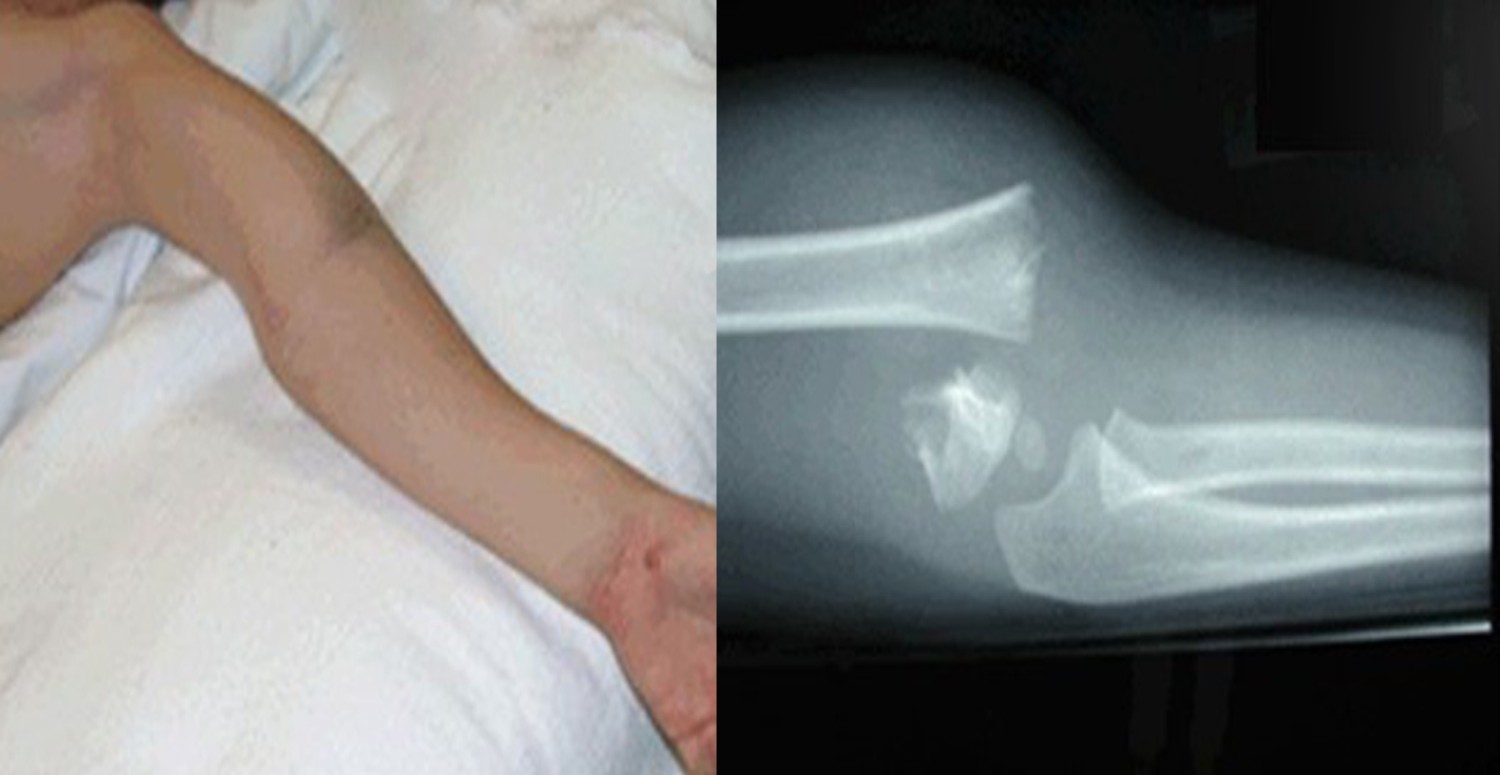 dirsek çıkığı tedavisi