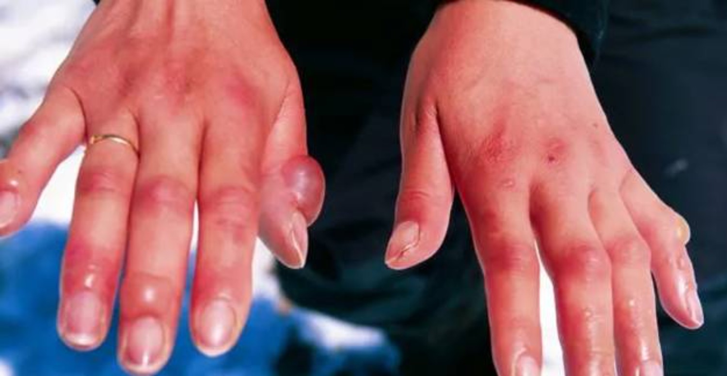 SOĞUK ISIRIĞI SONUCU