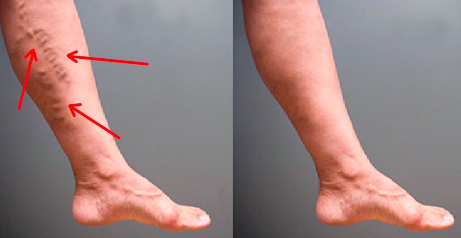 İÇ VARİS BELİRTİLERİ