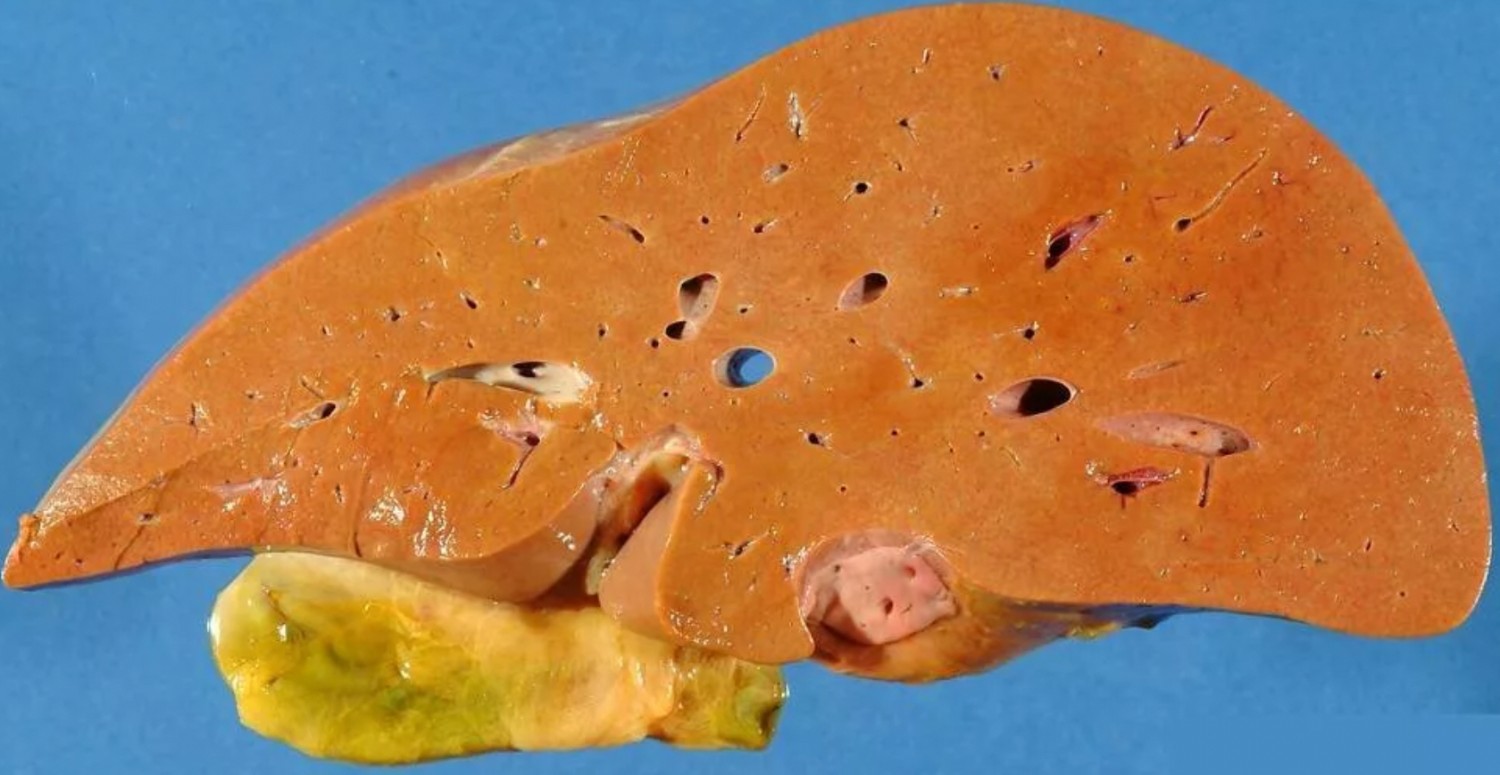 karaciğer çürümesi