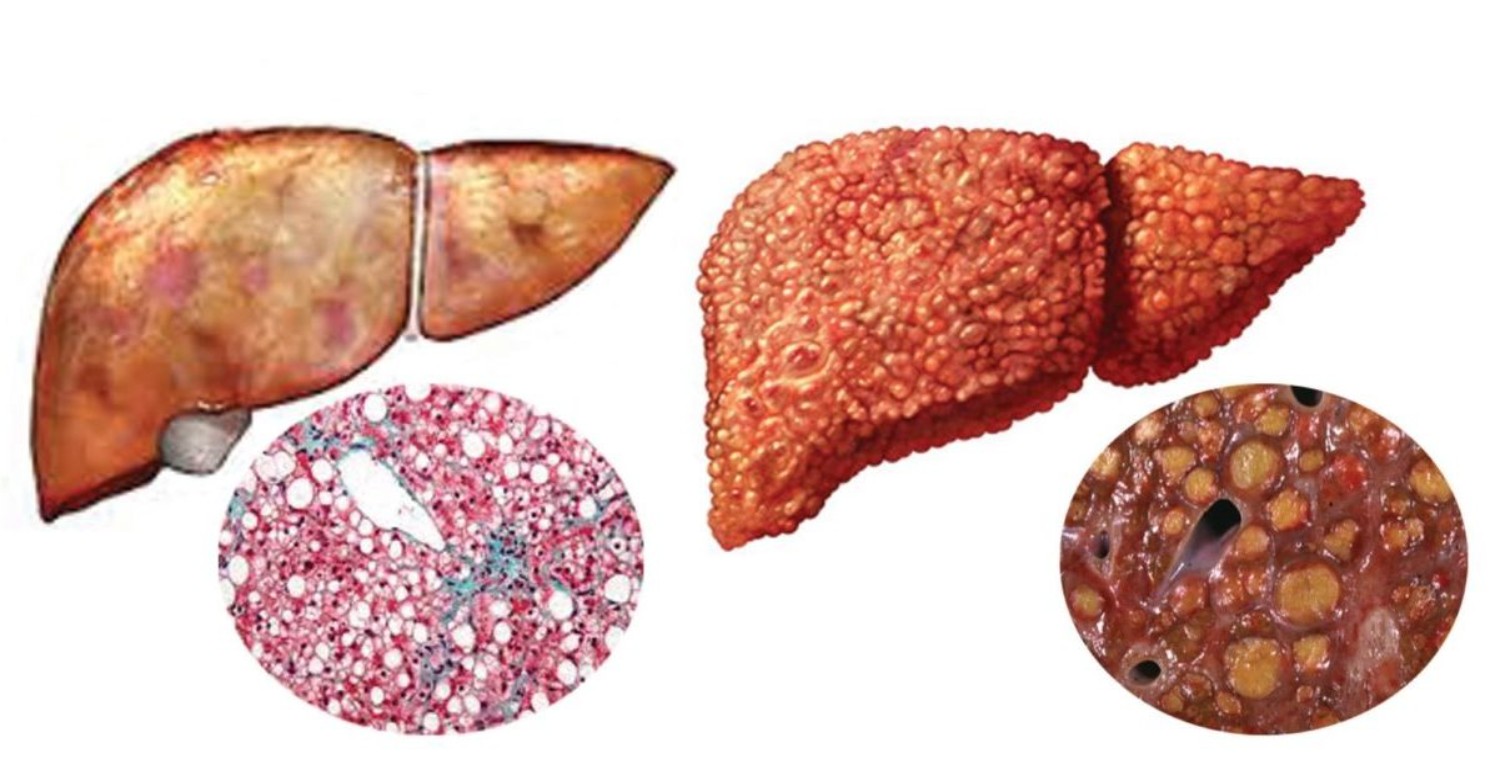 karaciğer çürümesinin nedenleri