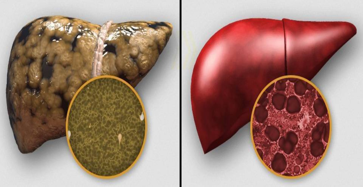 karaciğer yağlanması