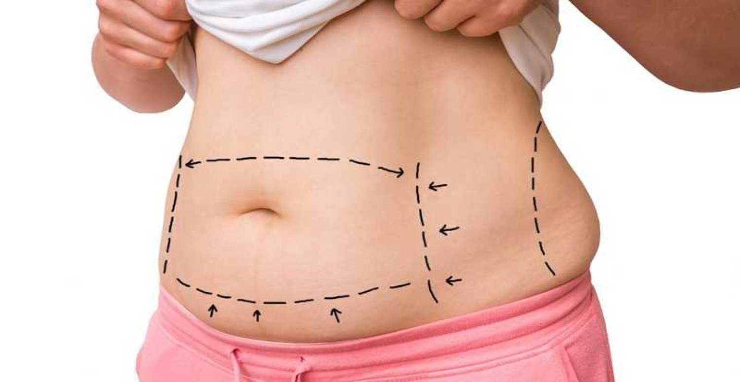 karında sıvı birikmesi