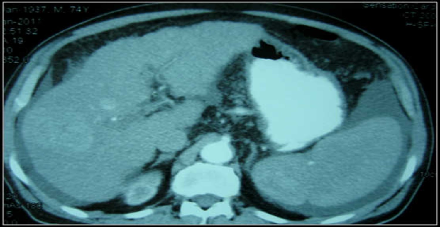 karında sıvı neden birikir