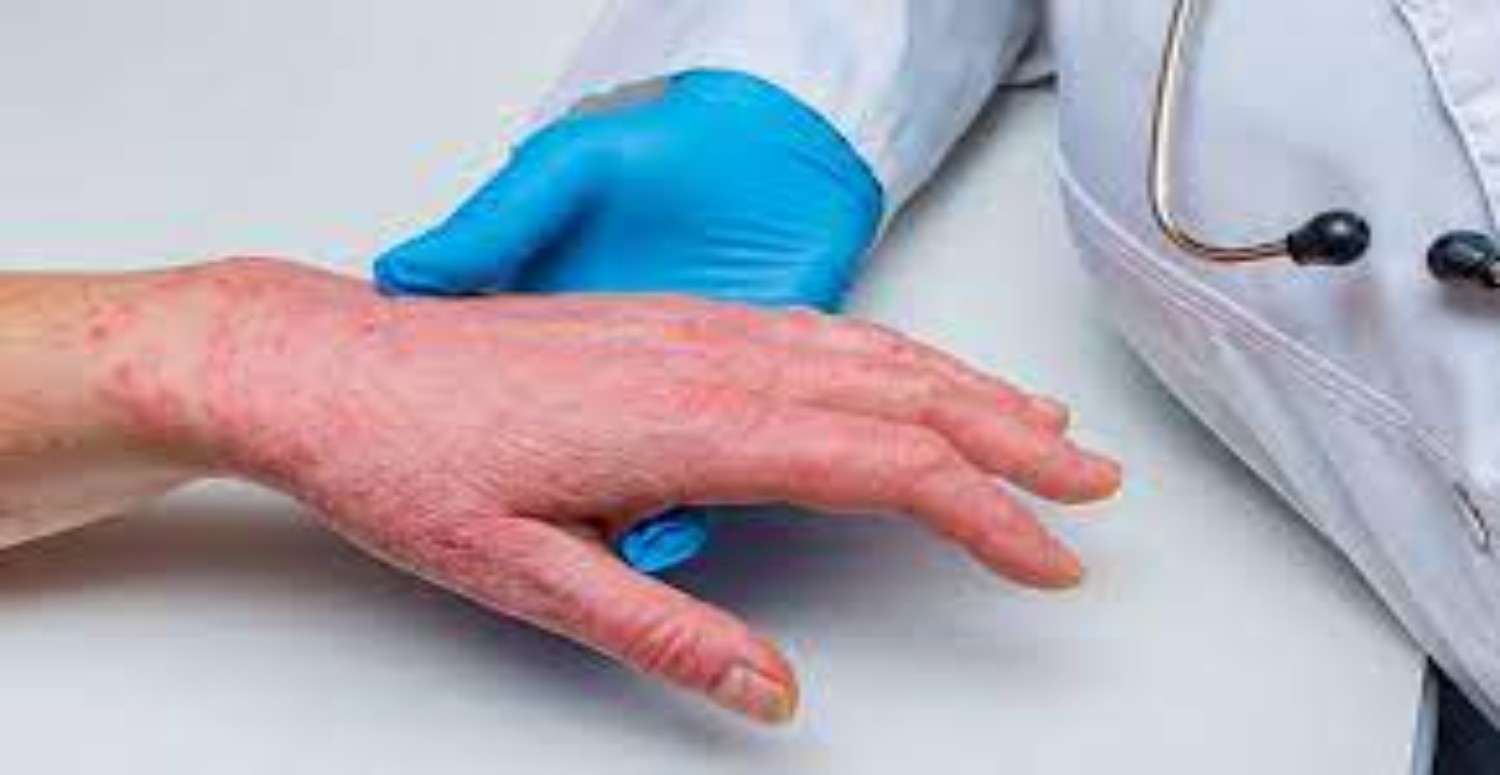 KIRMIZI ET ALARJİSİ