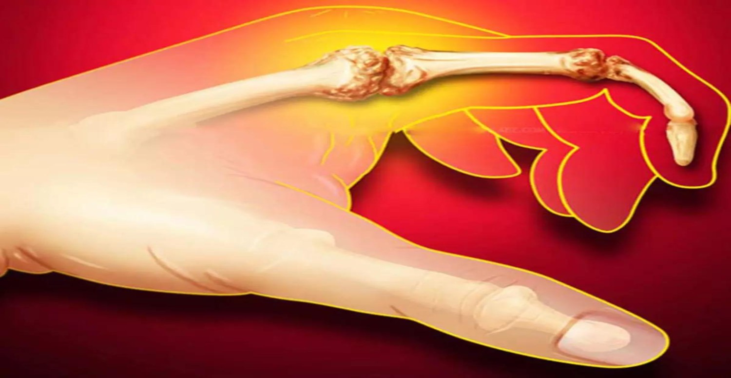 ÜRİK ASİT SEBEBİ