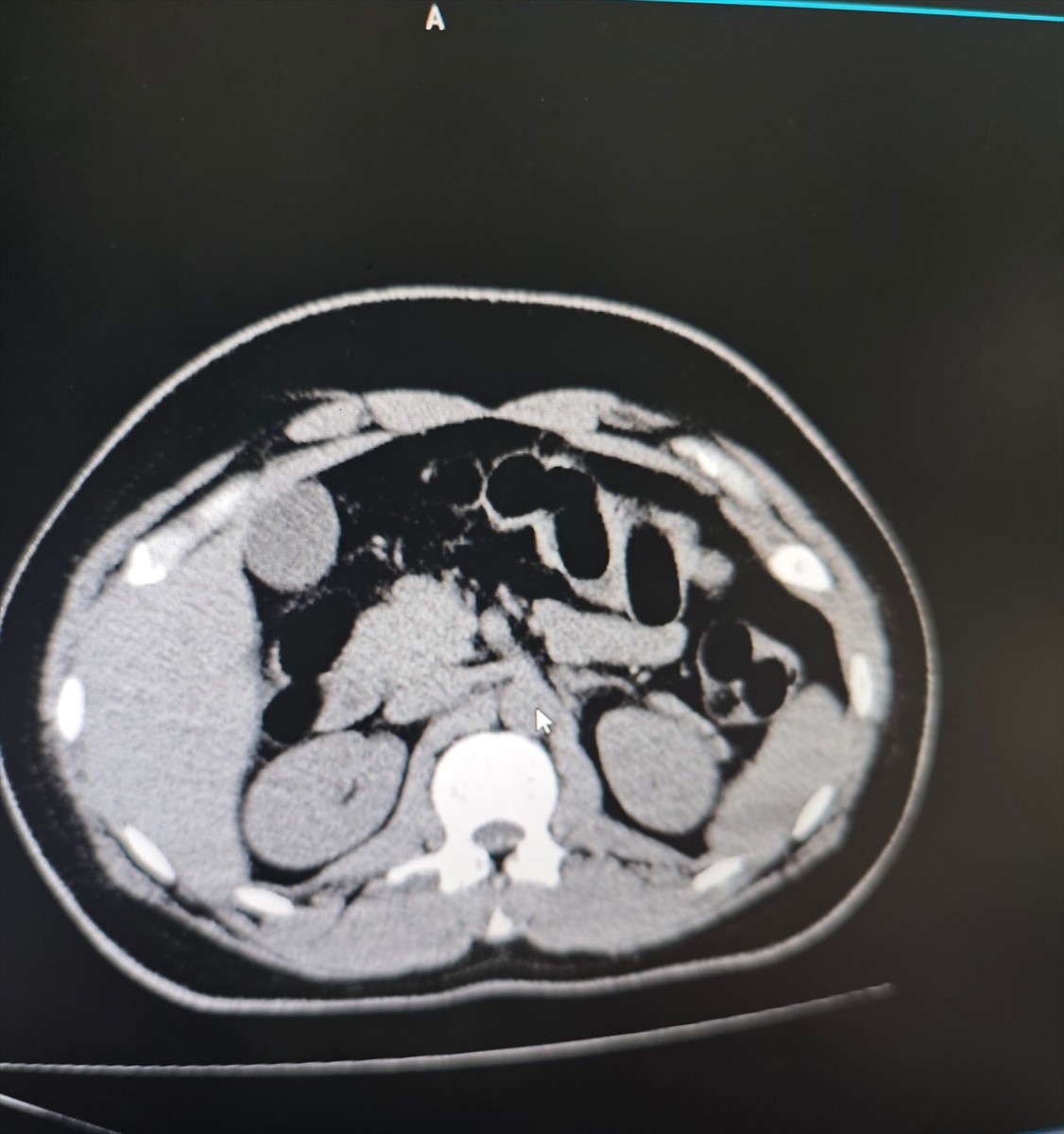 Muş'ta yolcu otobüsündeki bir şüphelinin midesinde, kapsüllere konulan 842 gram eroin ele...