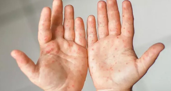 Kütahya Tavşanlı'da Şap Hastalığı Nedeniyle Karantina Başlatıldı