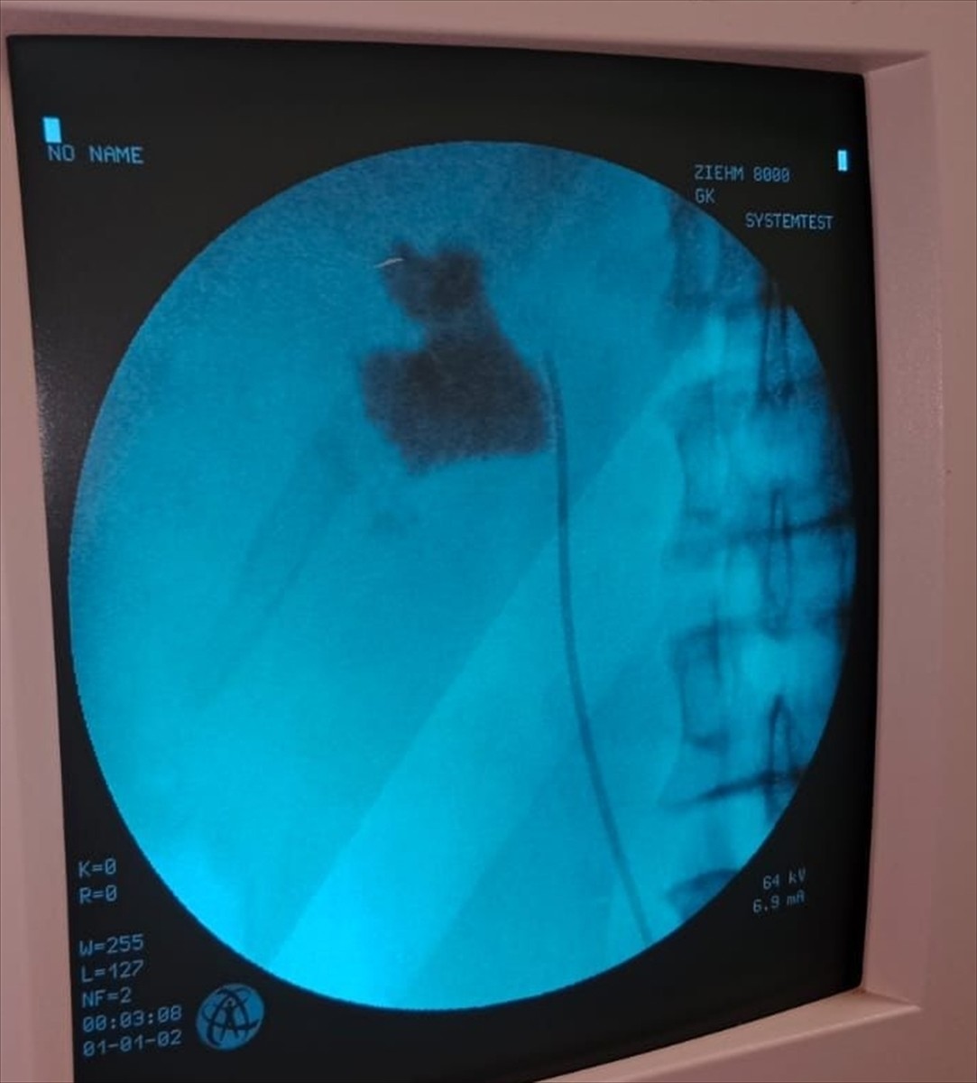 Kırşehir'de bir hastanın böbreğindeki 6 santimetrelik taş, kapalı ameliyatla alındı. Kırşehir...