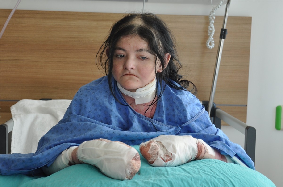 Halk arasında "kelebek hastalığı" olarak bilinen "epidermolysis bullosa (EB)" hastası 20 yaşındaki...