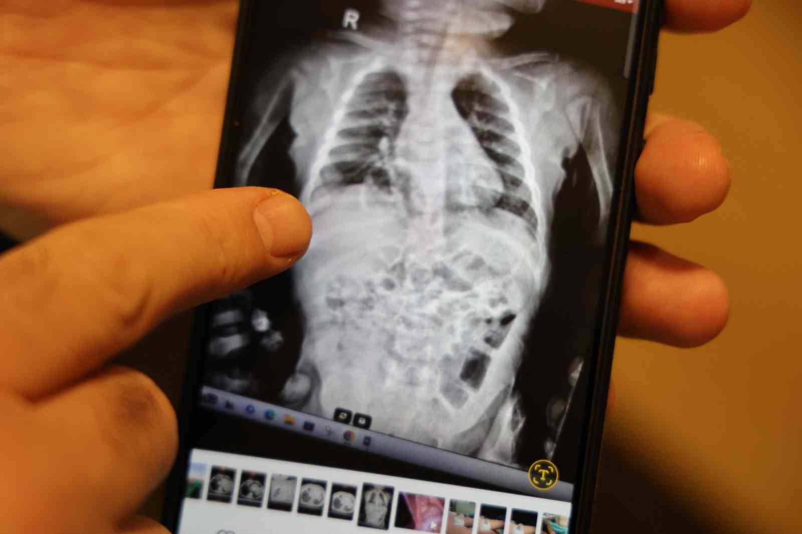 DİYARBAKIR’DA YAŞAYAN 2 YAŞINDAKİ TEVAB ARAM ZENGİN, DOĞUŞTAN BAĞIRSAKLARININ GÖĞÜS BOŞLUĞUNA...