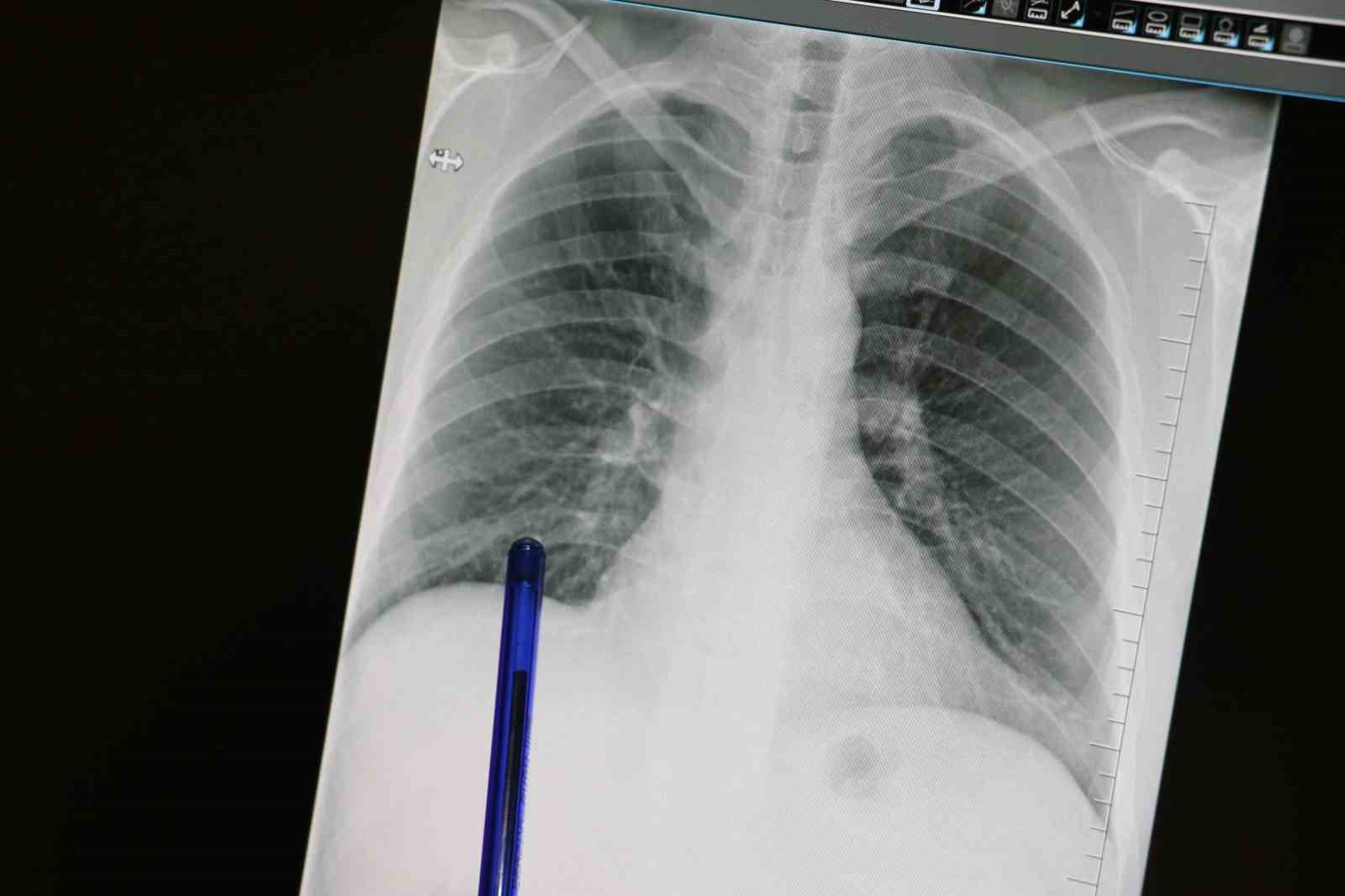 GÖĞÜS HASTALIKLARI UZMANI DR. BÜŞRA YAYLA YERLİKAYA, ÖKSÜRÜK VE BALGAM GİBİ BASİT GÖRÜNEN...