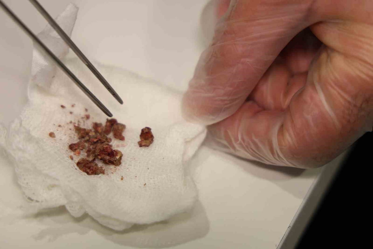 ELAZIĞ’DA BURUN ESTETİĞİ İÇİN AMELİYATA ALINAN BİR HASTANIN BURNUNDA TAŞ TESPİT...