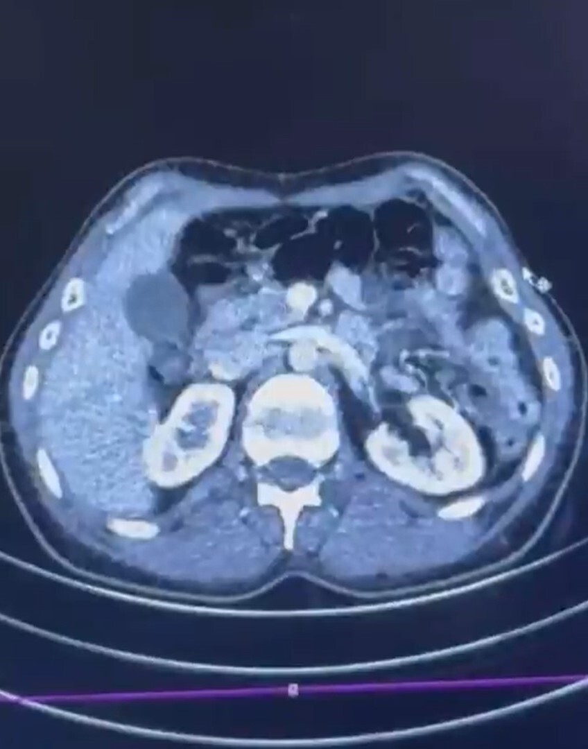 ŞÜPHELİLERİN MİDESİNDE KAPSÜL ŞEKLİNDE YARIM KİLO UYUŞTURUCU MADDE ELE GEÇİRİLDİ.