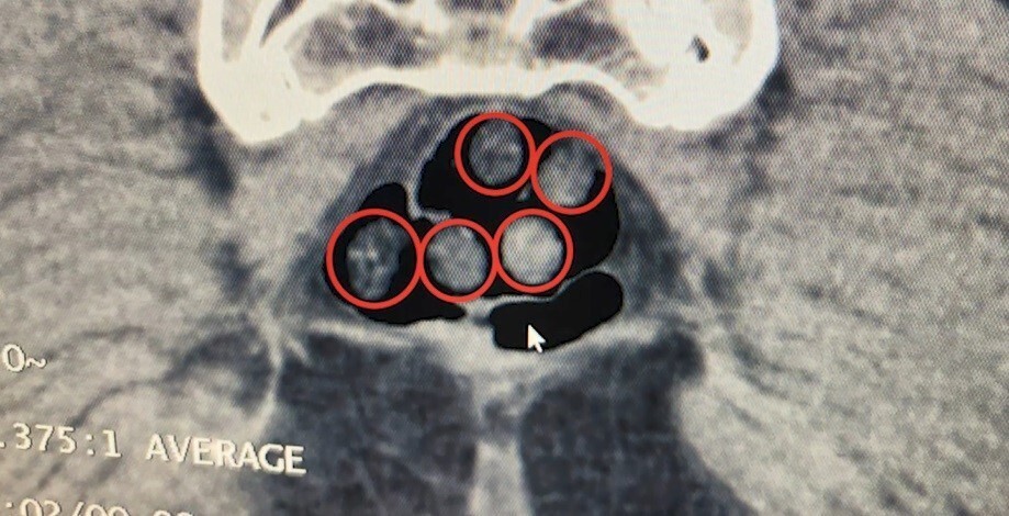 TATVAN DEVLET HASTANESİNDE YAPILAN RÖNTGEN VE TOMOGRAFİ İNCELEMELERİNDE, ŞAHISLARIN MİDE İLE...