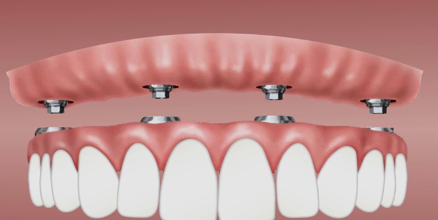 TBMM'ye Sunulan Teklif: SGK, Yerli İmplantları Kişi Başına 4 Adede Kadar Karşılamayı Öngörüyor