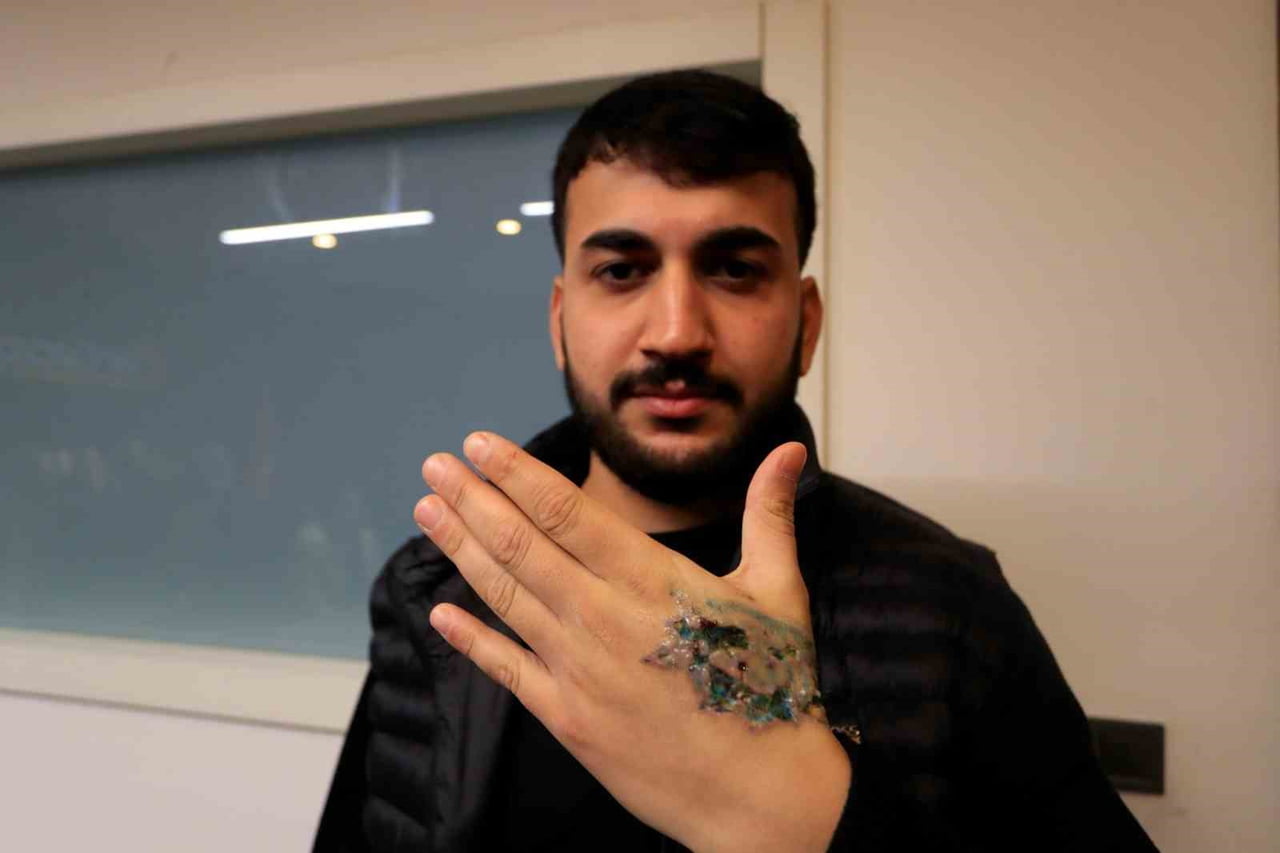 BİR GÜZELLİK MERKEZİNDE ELİNDEKİ DÖVMEYİ SİLDİRMEK İSTEYEN YASİN TAŞ’IN SOL ELİNDE HATALI UYGULAMA...