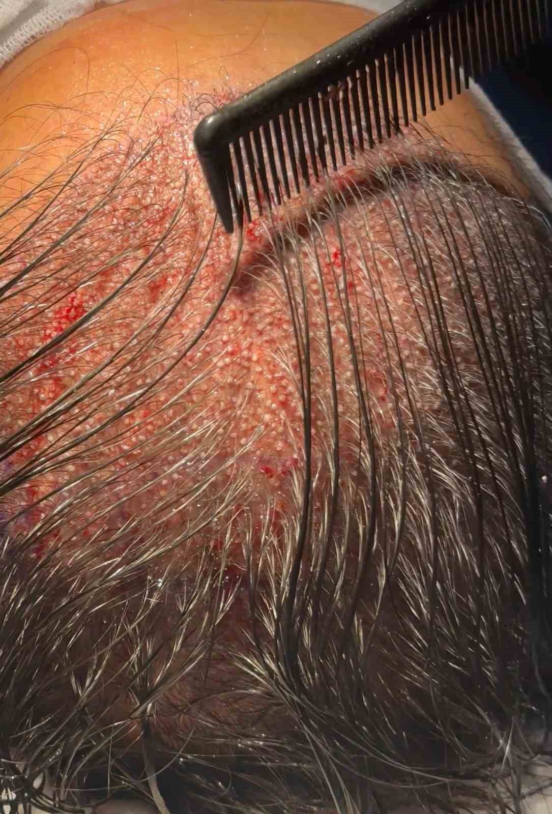 ESTETİK VE PLASTİK CERRAHİ UZMANI PROF. DR. HAYATİ AKBAŞ, SON YILLARDA GELİŞEN DHİ (DİRECT HAİR...