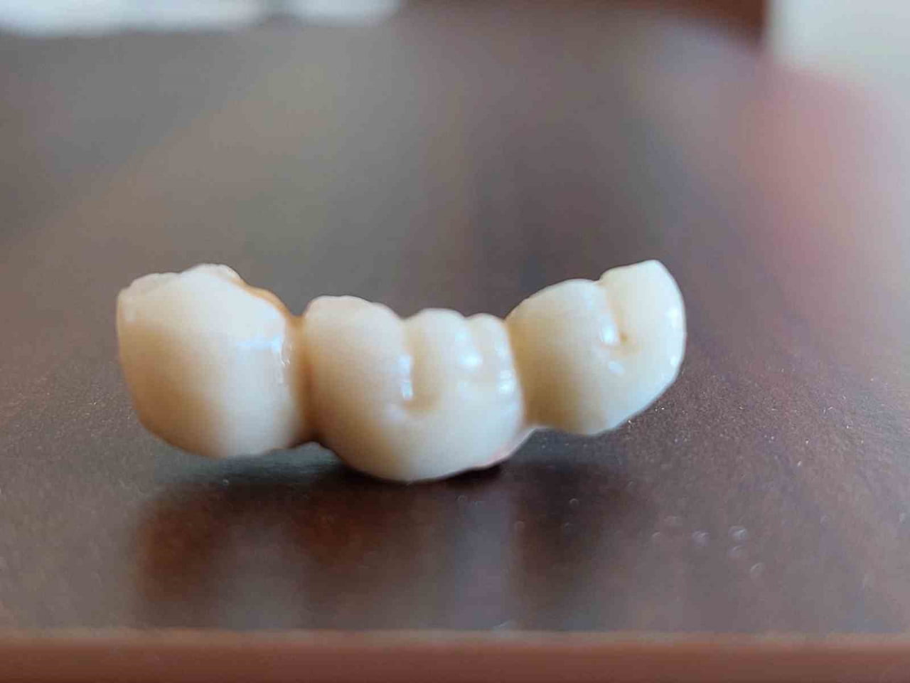 KAYSERİ’DE 2 YIL ÖNCE ÖZEL BİR KLİNİKTE YAPTIRDIĞI İMPLANTLARIN SÜREKLİ DÜŞMESİ SONUCUNDA YAPILAN...