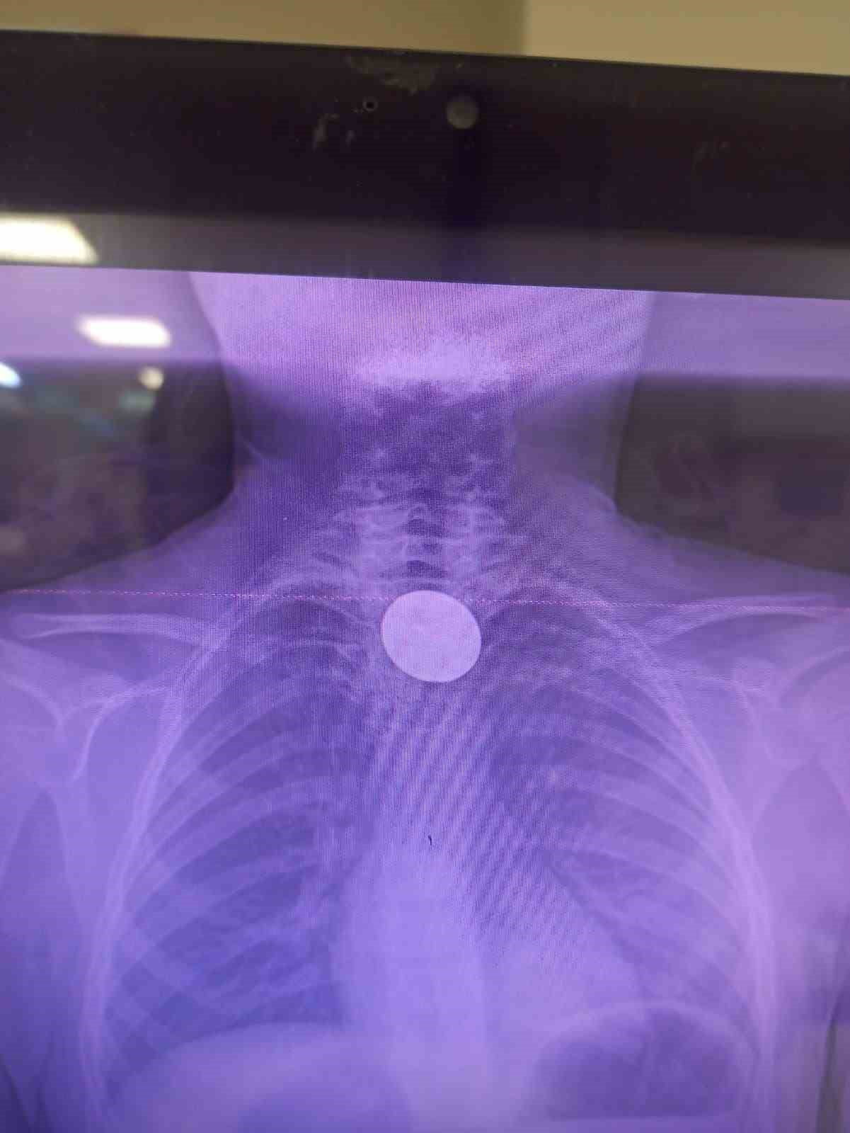 SİİRT'TE BOĞAZINA MADENİ 5 LİRA KAÇAN 8 YAŞINDAKİ ÇOCUK, HASTANEDE DOKTOR MÜDAHALESİYLE...