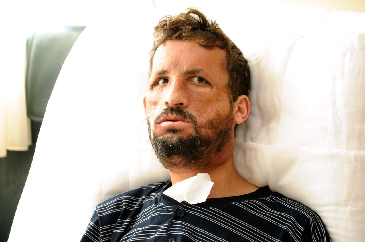 TÜRKİYE’NİN İLK YÜZ NAKLİ OPERASYONU YAPILAN UĞUR ACAR, NAKLİN 14. YIL DÖNÜMÜNDE AKDENİZ...