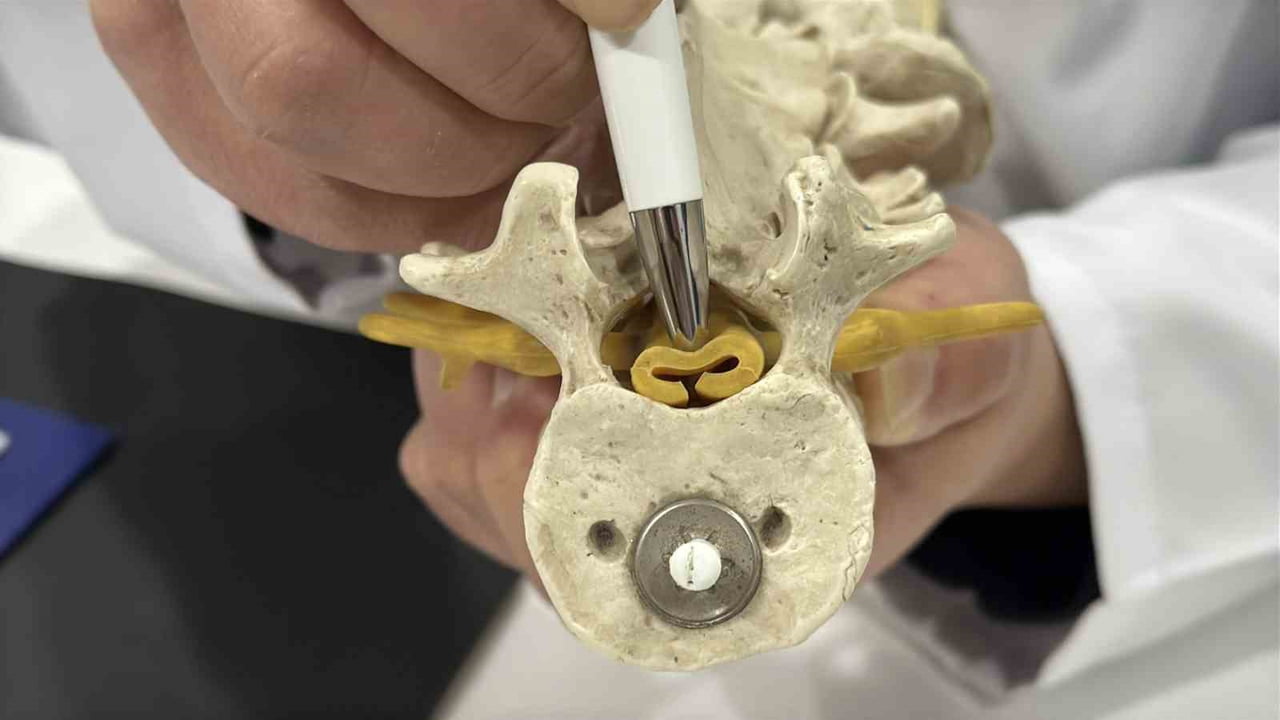 BEL FITIĞIYLA BENZER BELİRTİLER GÖSTEREN VE TEDAVİ EDİLMEDİĞİNDE KALICI HASARLARA YOL AÇABİLEN...