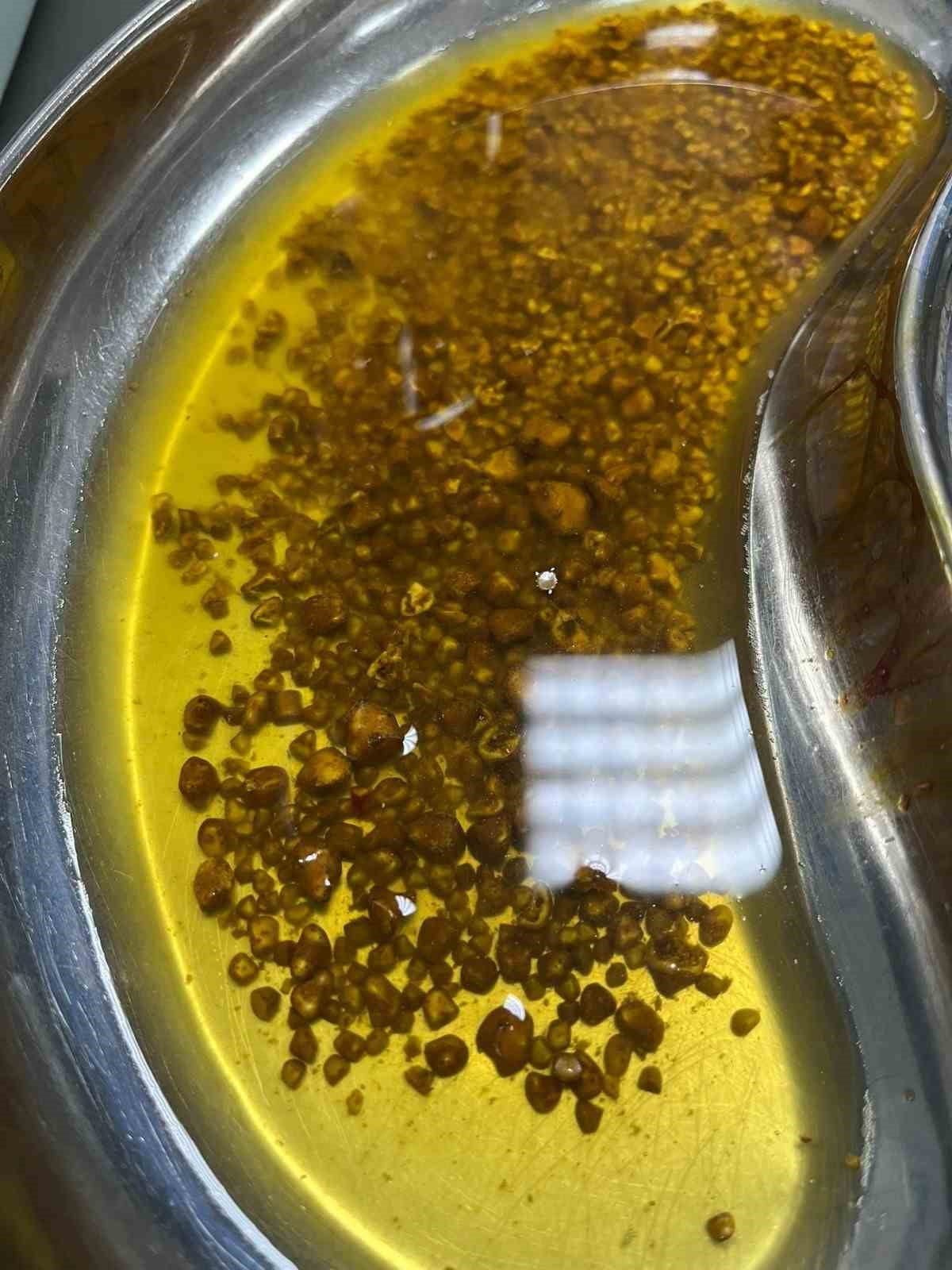 BİNGÖL’DE NADİR VAKA: SAFRA KESESİNDEN 2067 TAŞ ÇIKARILDI