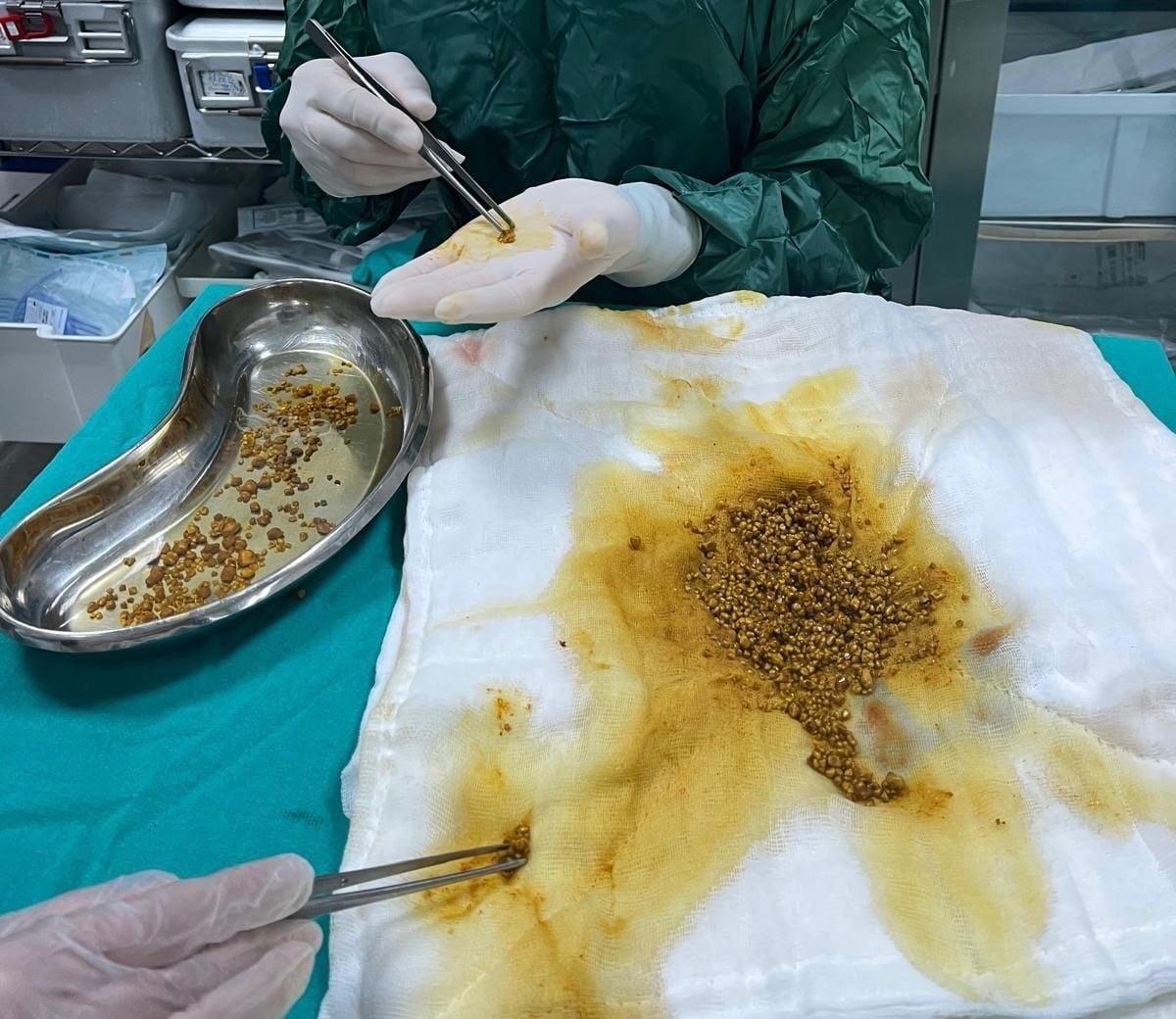 BİNGÖL’DE NADİR VAKA: SAFRA KESESİNDEN 2067 TAŞ ÇIKARILDI