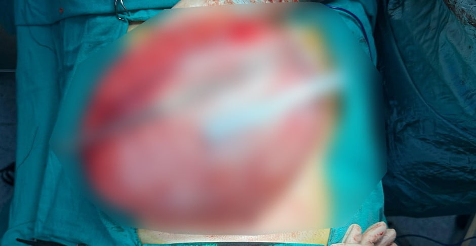 BOLU’DA FAZLA KİLOLARINDAN KURTULMAK İÇİN HASTANEYE BAŞVURAN LİSE ÖĞRENCİSİNİN KARNINDAN 3,5...