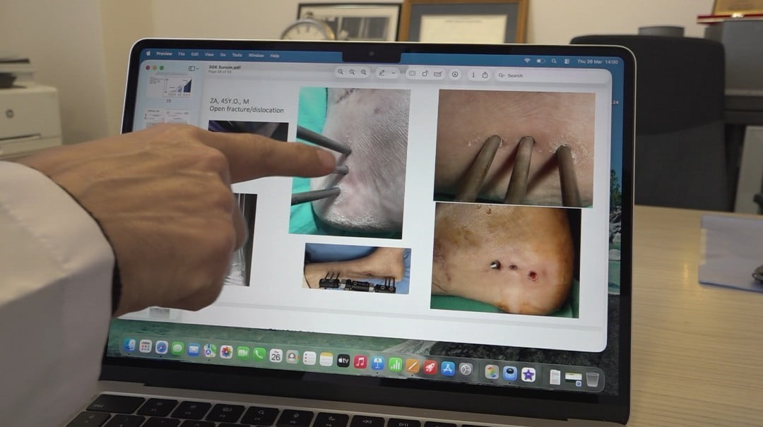 DÜNYANIN İLK ENFEKSİYONLU BÖLGEYE UYGULANABİLEN YAPAY KEMİĞİ ESKİŞEHİR'DE...