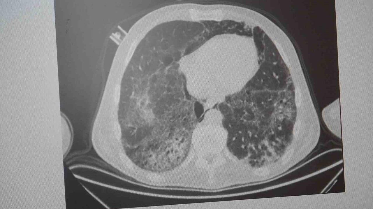 MARMARA ÜNİVERSİTESİ PENDİK EĞİTİM VE ARAŞTIRMA HASTANESİ GÖĞÜS HASTALIKLARI KLİNİĞİ’NDEN PROF....